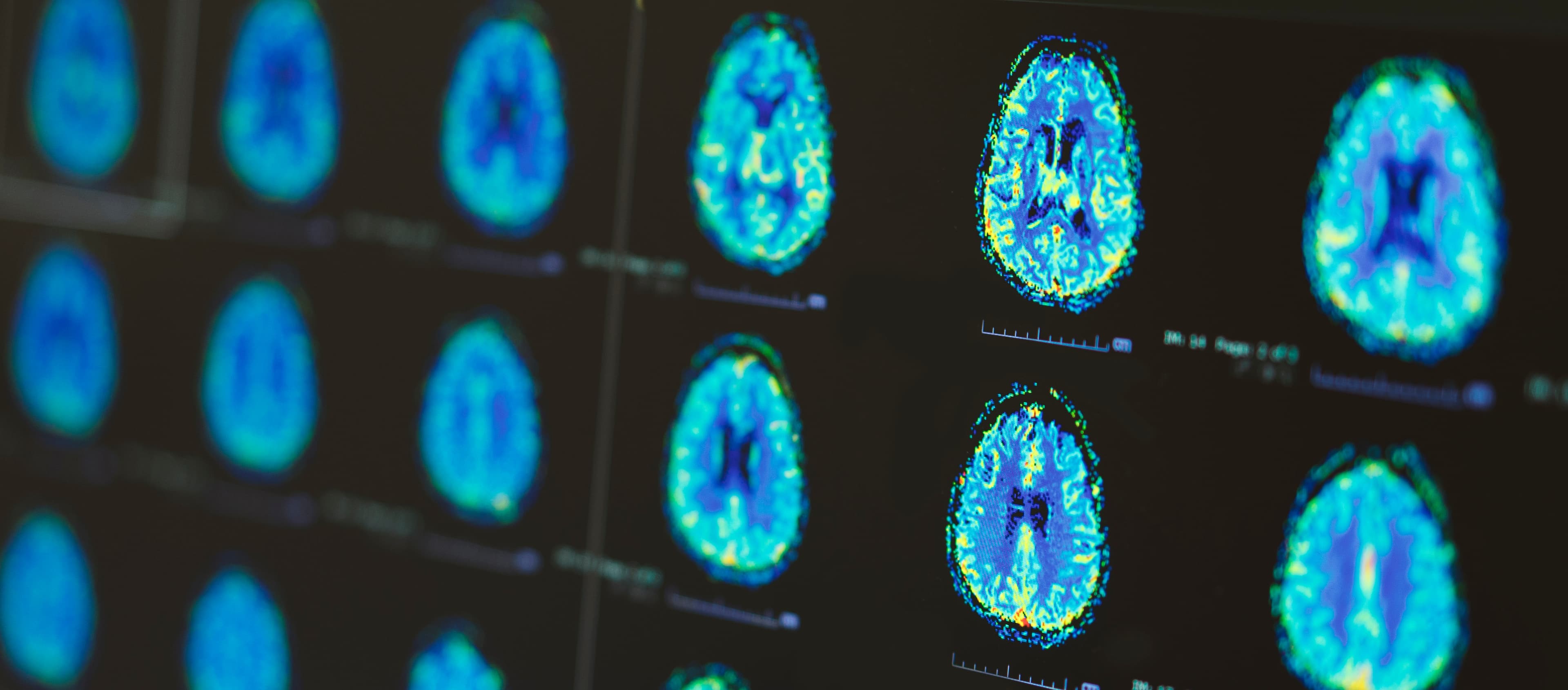 White Matter Disorders